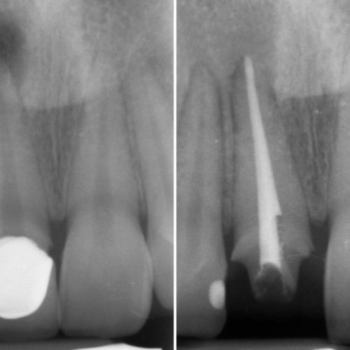 Endodonzia