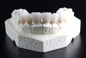Denti Implantologia