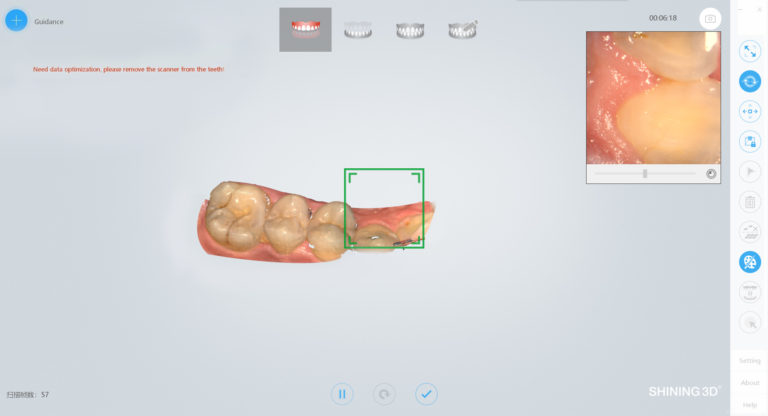 Scansione Intraorale - Studio Dentistico Cirillo - Agropoli e Salerno