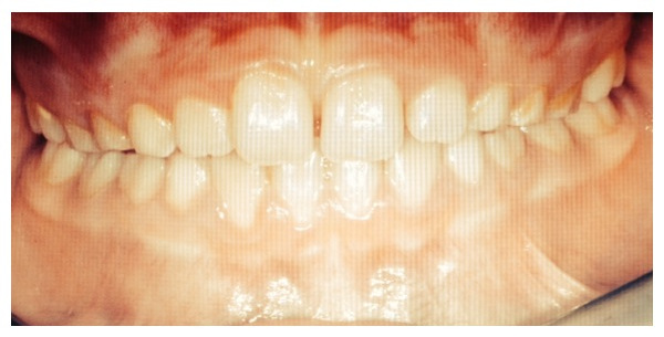 Caso Ortodonzia Intercettiva Dentista Agropoli Salerno