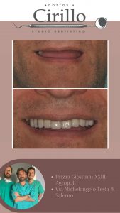Dentatura Fissa Protesi - Implantologia Dentale